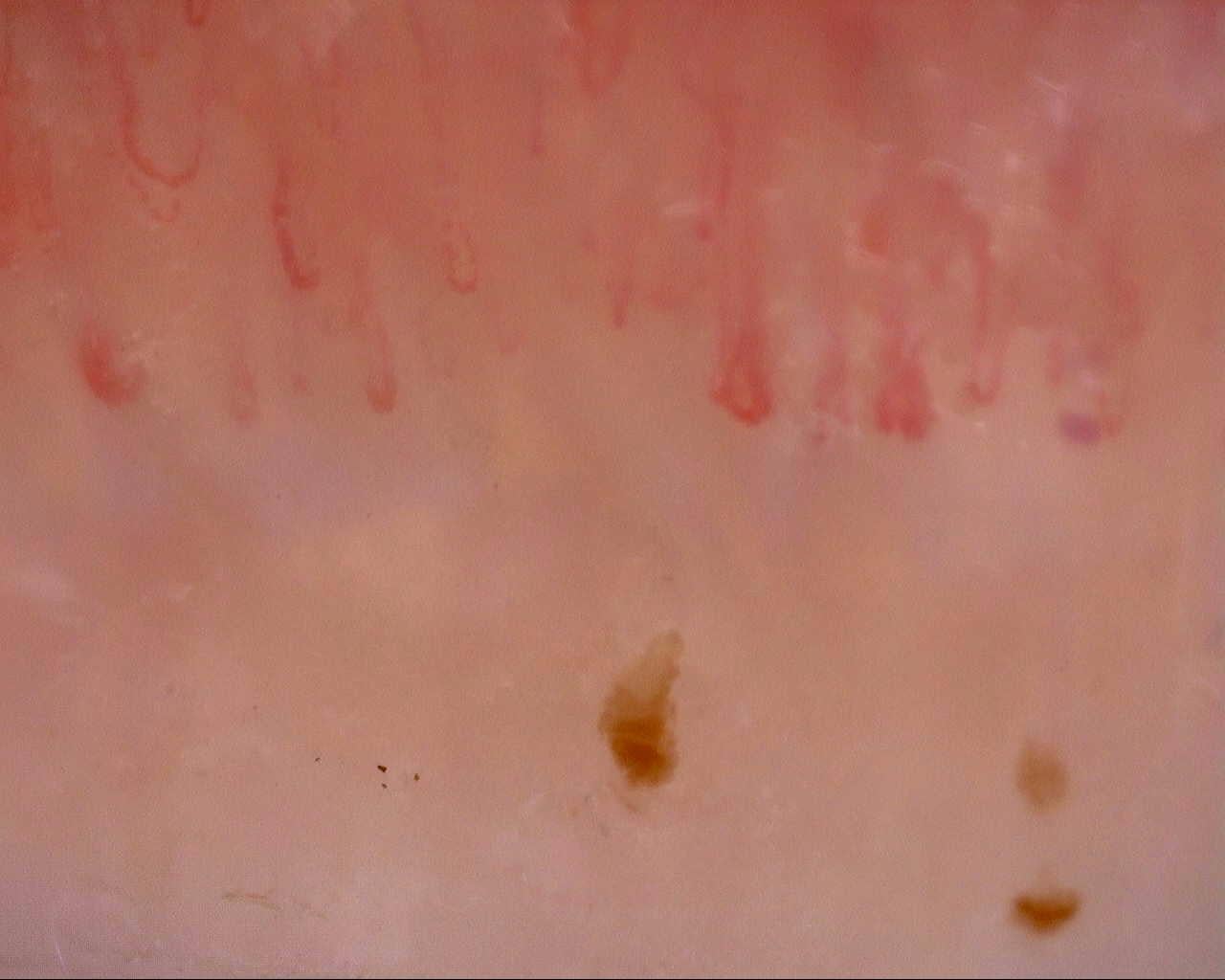 Nailfold capillaroscopy: left middle finger, field b. Initial study. Mixed Connective Tissue Disease Presenting with Raynaud Phenomenon.