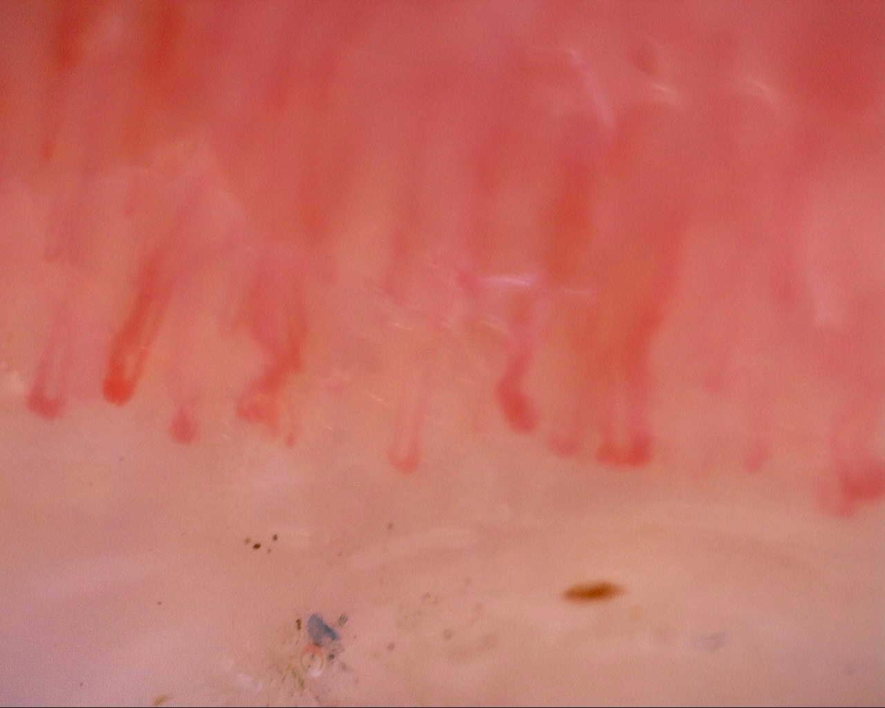 Nailfold capillaroscopy: right index finger, field c. Initial study. Mixed Connective Tissue Disease Presenting with Raynaud Phenomenon.