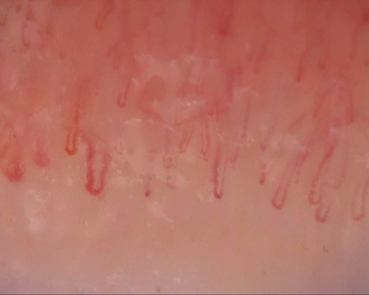 Nailfold capillaroscopy: right ring finger, field b. Initial study. Mixed Connective Tissue Disease Presenting with Raynaud Phenomenon.