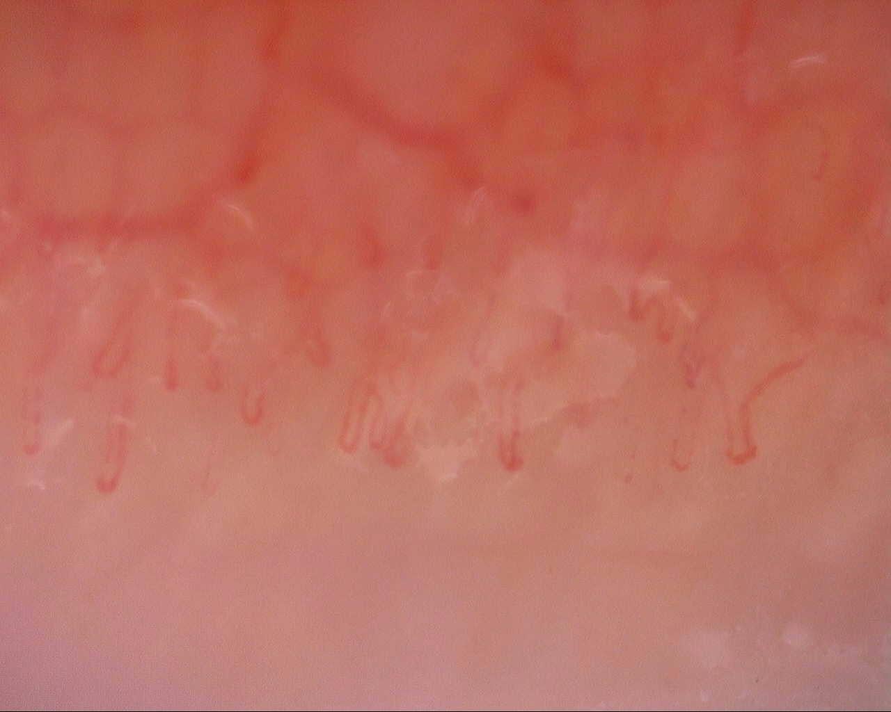 Nailfold capillaroscopy: right little finger, field b. Initial study. Mixed Connective Tissue Disease Presenting with Raynaud Phenomenon.