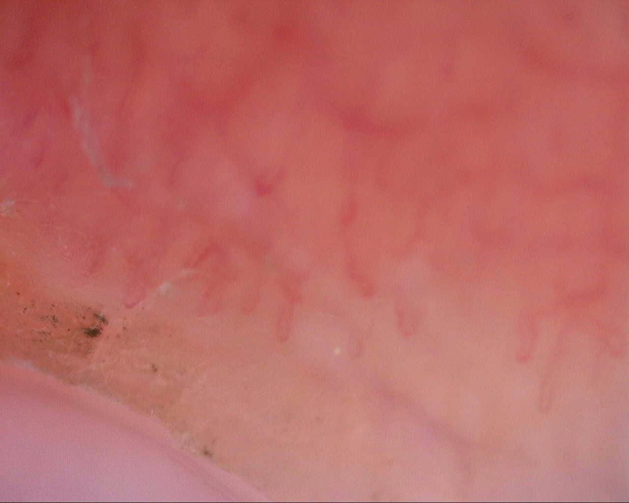 Nailfold capillaroscopy: left little finger, field a. Initial study. Mixed Connective Tissue Disease Presenting with Raynaud Phenomenon.