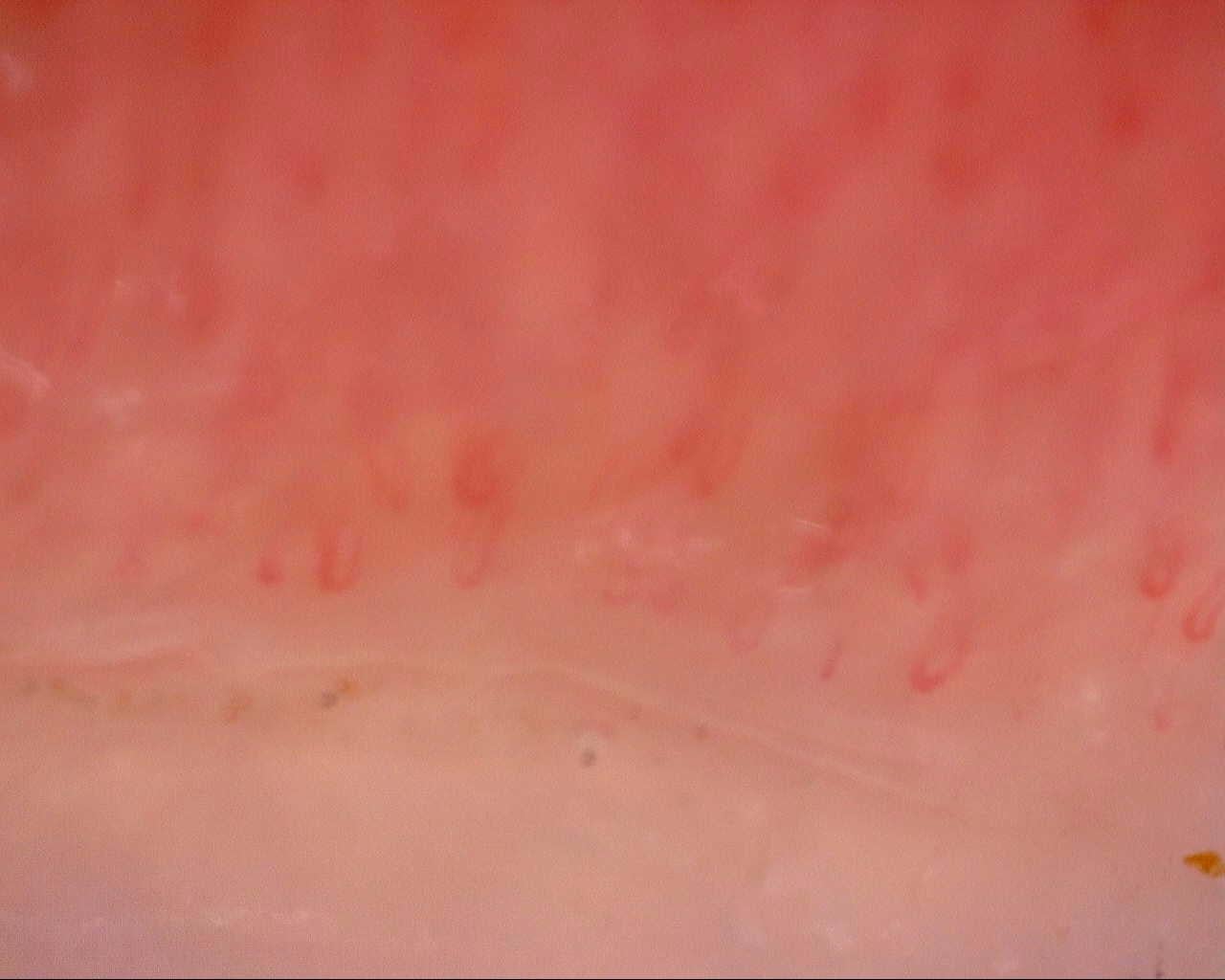 Nailfold capillaroscopy: right middle finger, field c. Initial study. Mixed Connective Tissue Disease Presenting with Raynaud Phenomenon.