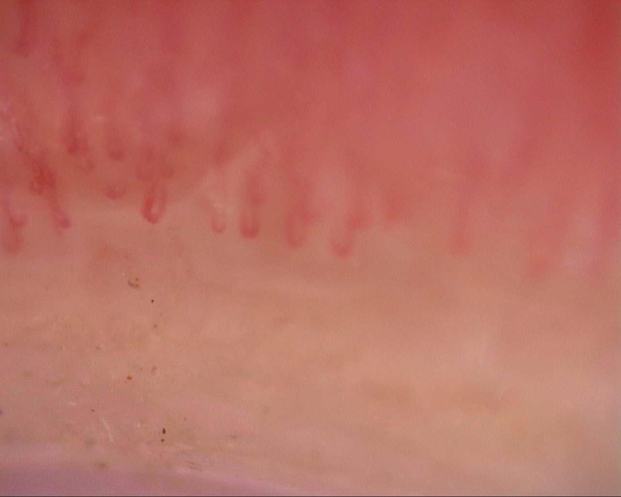 Nailfold capillaroscopy: left index finger, field a. Initial study. Mixed Connective Tissue Disease Presenting with Raynaud Phenomenon.