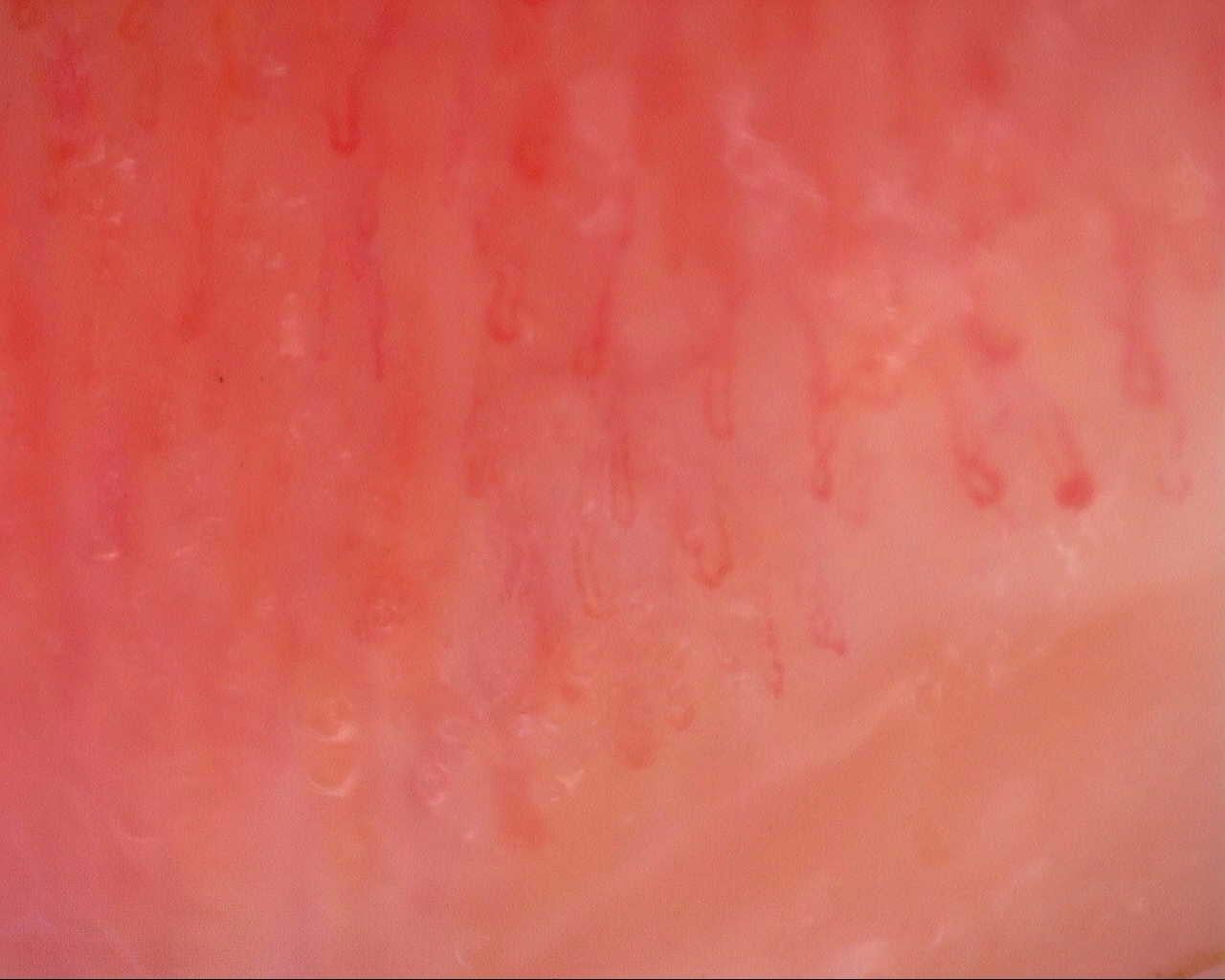 Nailfold capillaroscopy: left index finger, field d. Initial study. Mixed Connective Tissue Disease Presenting with Raynaud Phenomenon.
