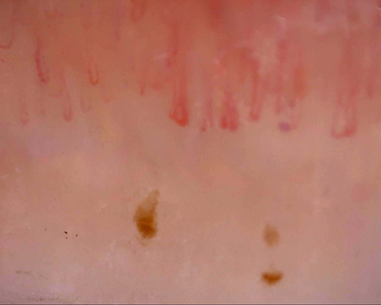 Nailfold capillaroscopy: left middle finger, field b. Initial study. Mixed Connective Tissue Disease Presenting with Raynaud Phenomenon.