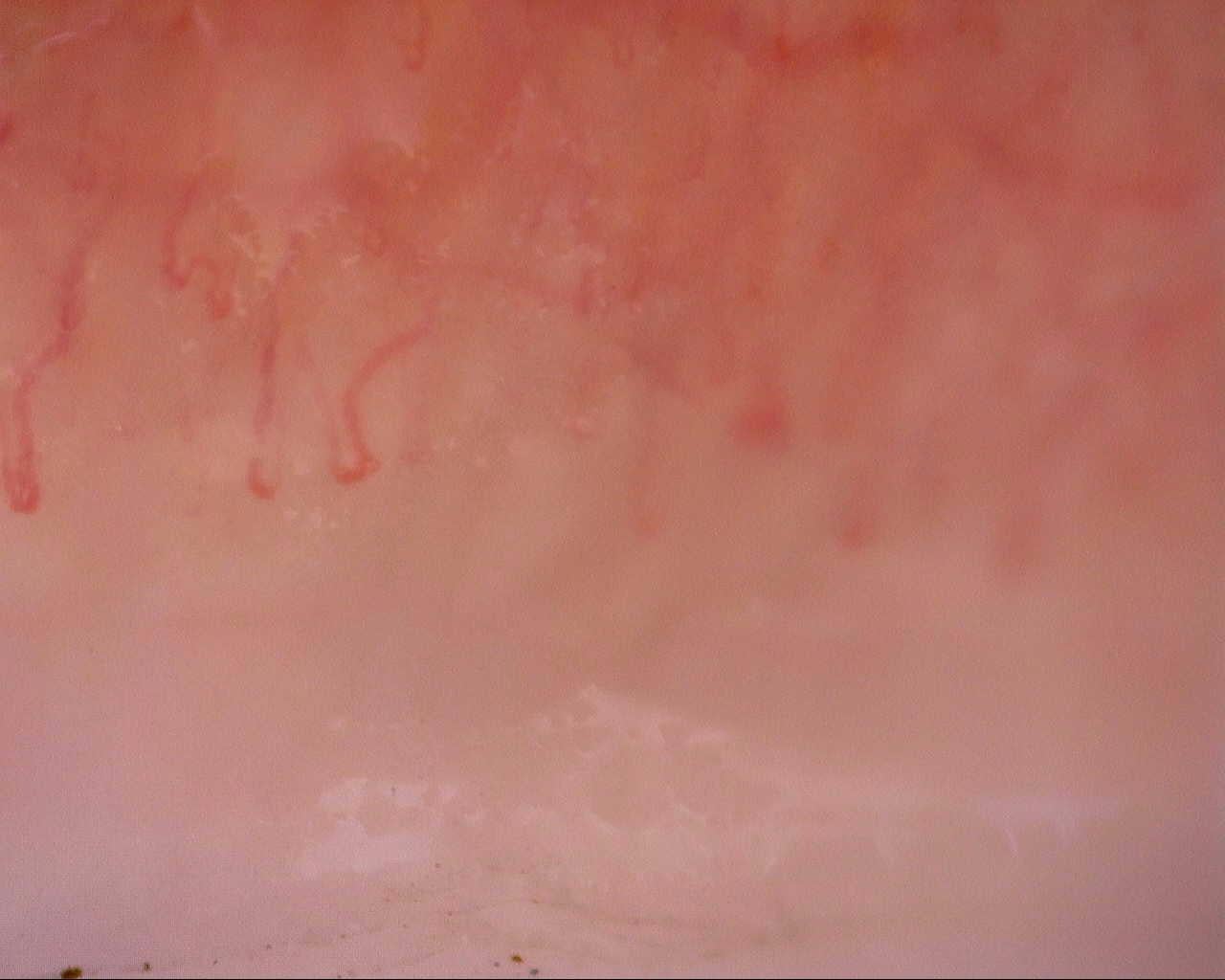 Nailfold capillaroscopy: right little finger, field d. Initial study. Mixed Connective Tissue Disease Presenting with Raynaud Phenomenon.