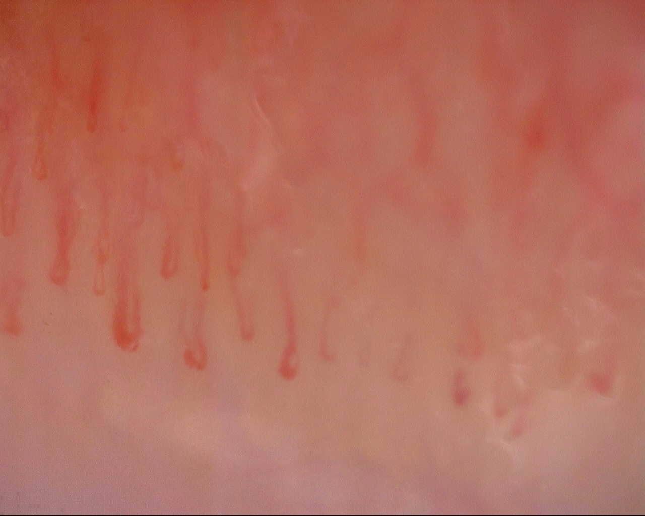 Nailfold capillaroscopy: left ring finger, field b. Initial study. Mixed Connective Tissue Disease Presenting with Raynaud Phenomenon.