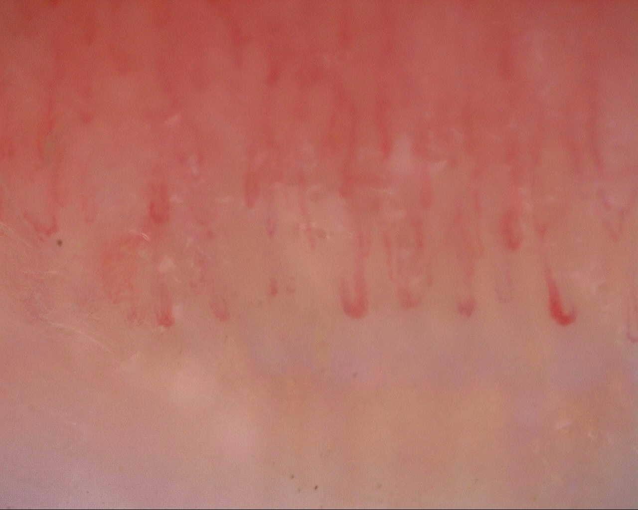 Nailfold capillaroscopy: left middle finger, field c. Initial study. Mixed Connective Tissue Disease Presenting with Raynaud Phenomenon.