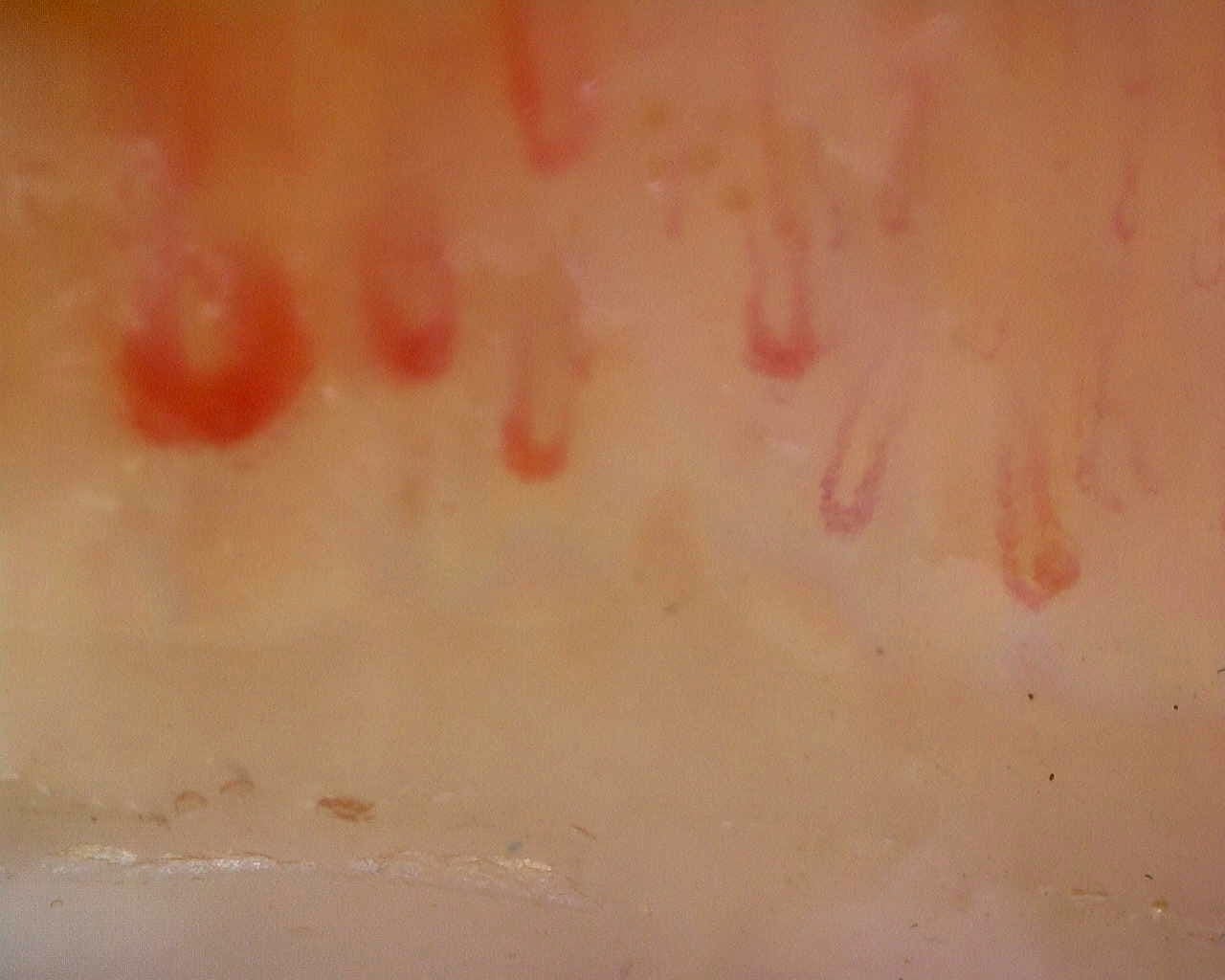 Nailfold capillaroscopy: right middle finger, field a. Limited Cutaneous Systemic Sclerosis (ACA+) with Active Cutolo Pattern.
