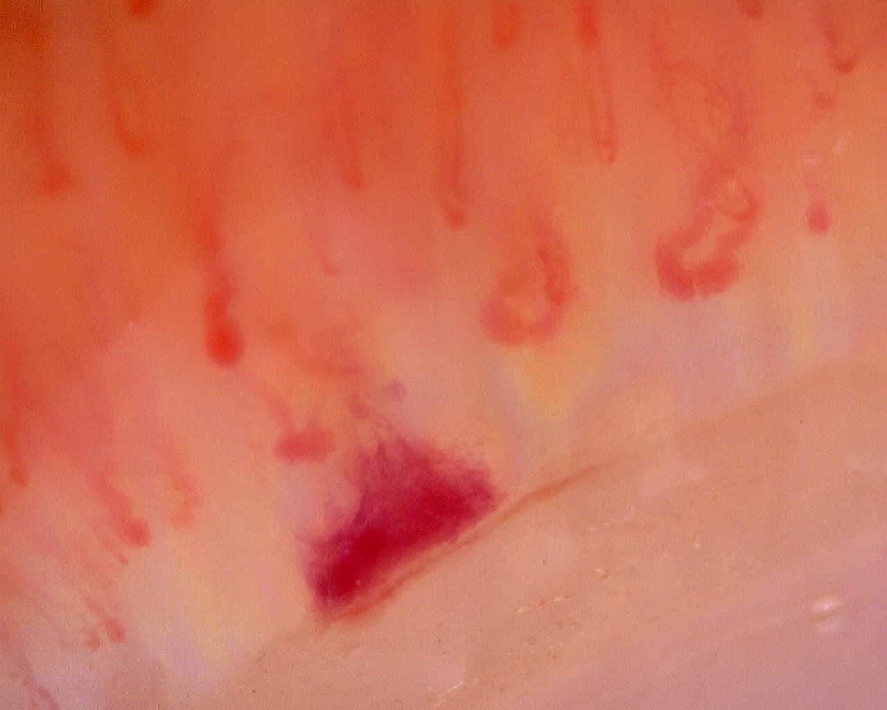 Nailfold capillaroscopy: right ring finger, field d. Limited Cutaneous Systemic Sclerosis (ACA+) with Active Cutolo Pattern.