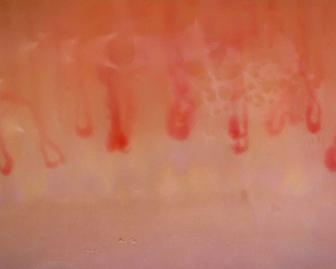 Nailfold capillaroscopy: right ring finger, field c. Limited Cutaneous Systemic Sclerosis (ACA+) with Active Cutolo Pattern.