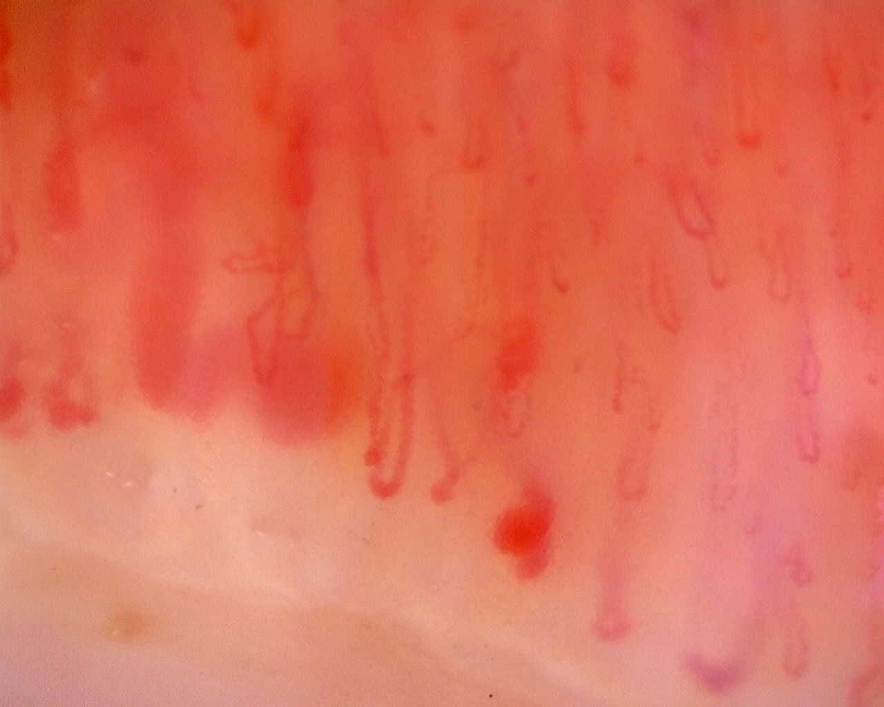 Nailfold capillaroscopy: left ring finger, field d. Limited Cutaneous Systemic Sclerosis (ACA+) with Active Cutolo Pattern.