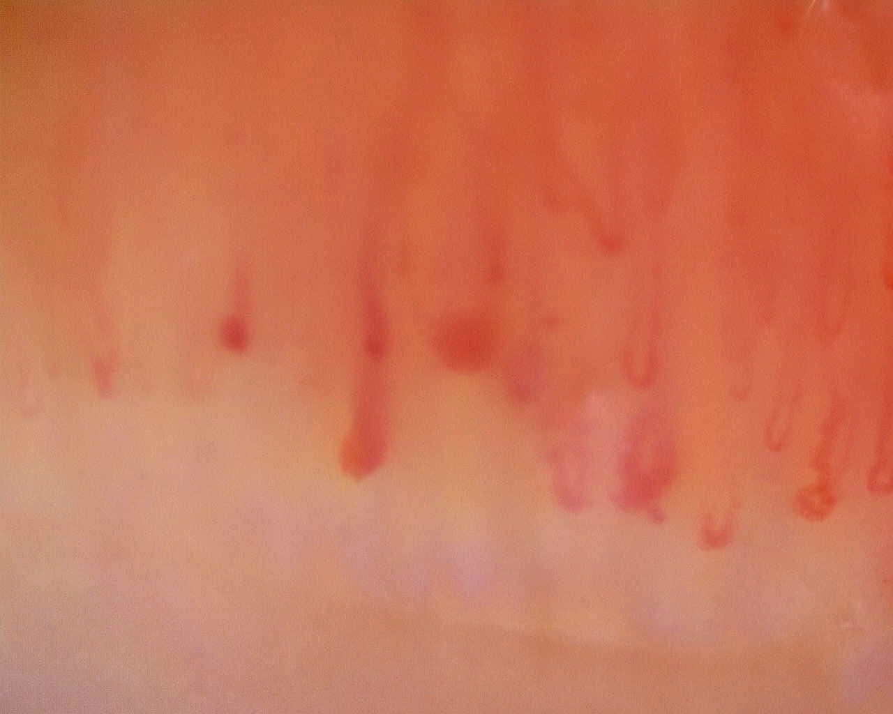Nailfold capillaroscopy: right little finger, field b. Limited Cutaneous Systemic Sclerosis (ACA+) with Active Cutolo Pattern.