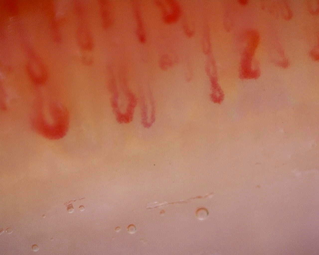 Nailfold capillaroscopy: right middle finger, field c. Limited Cutaneous Systemic Sclerosis (ACA+) with Active Cutolo Pattern.