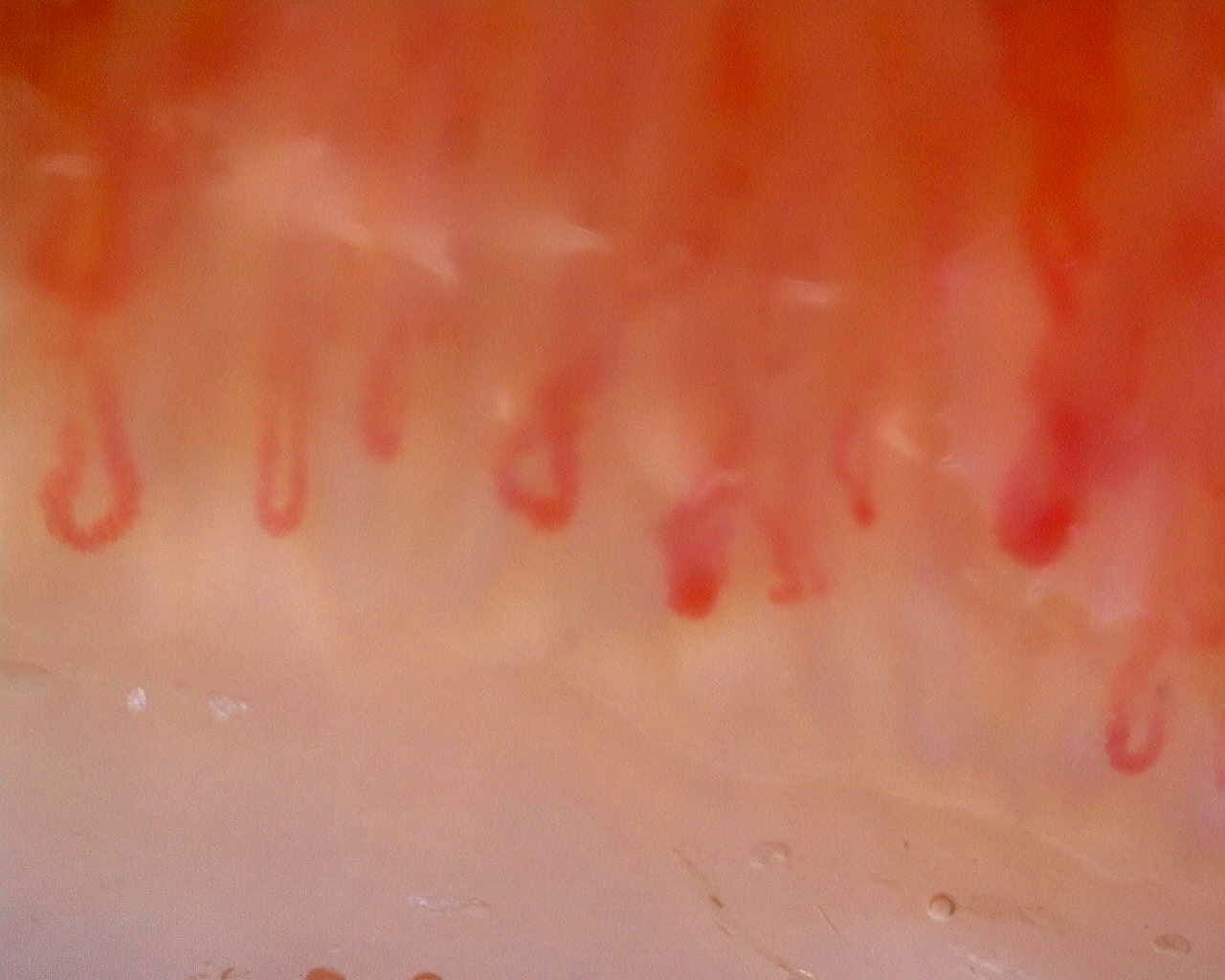 Nailfold capillaroscopy: left index finger, field d. Limited Cutaneous Systemic Sclerosis (ACA+) with Active Cutolo Pattern.