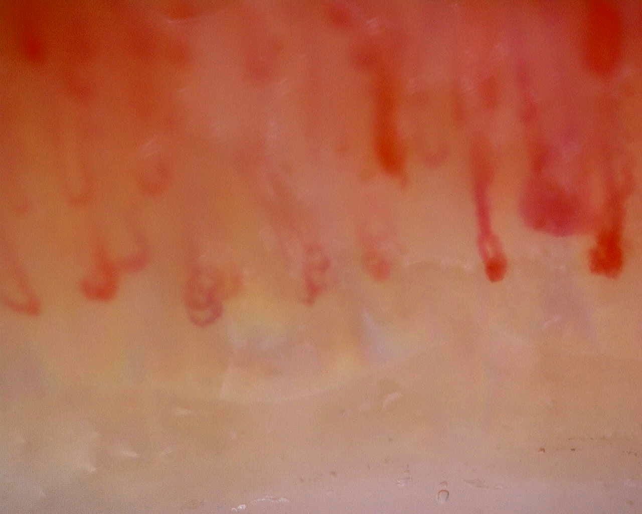 Nailfold capillaroscopy: right middle finger, field b. Limited Cutaneous Systemic Sclerosis (ACA+) with Active Cutolo Pattern.