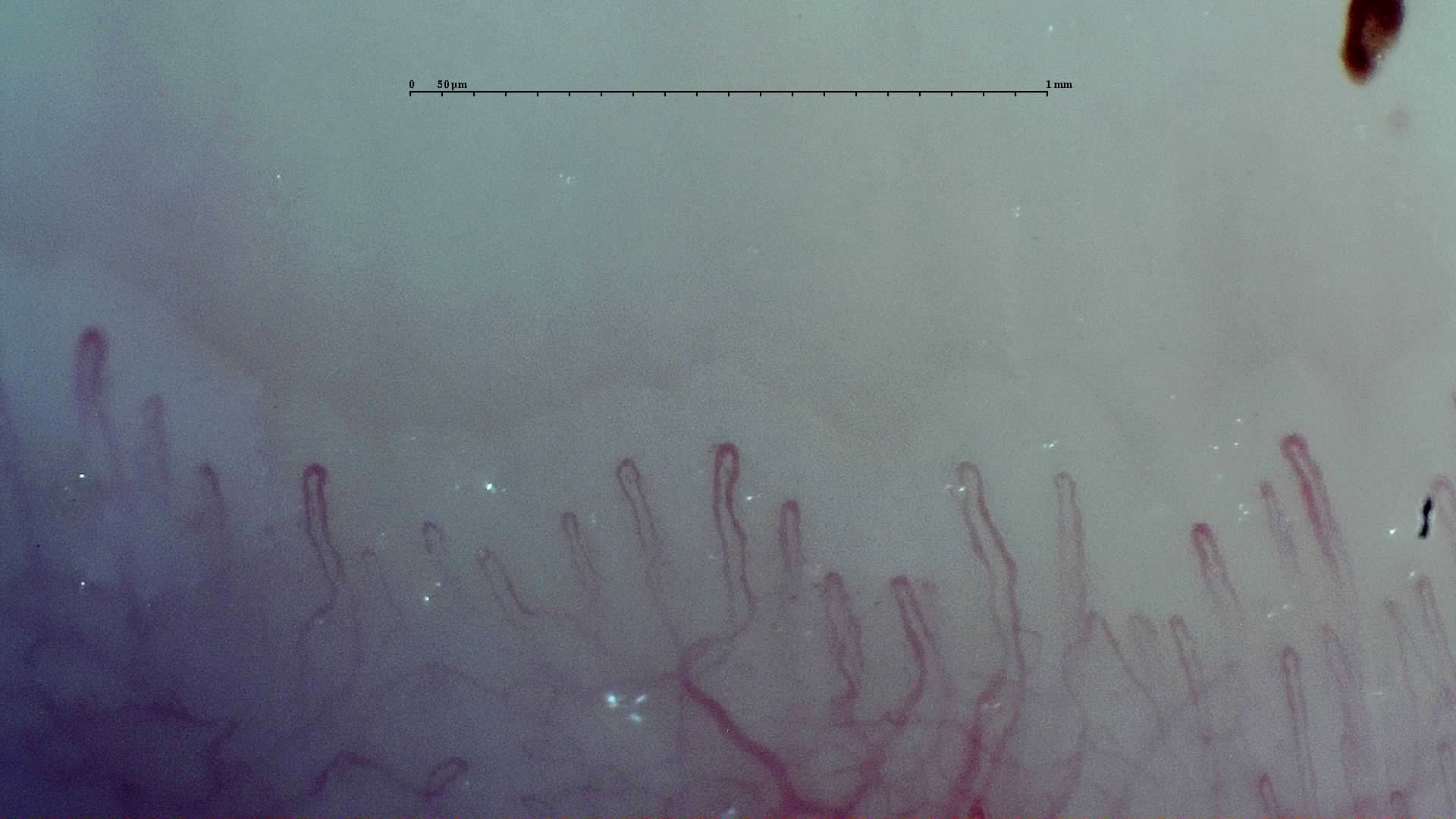 Nailfold capillaroscopy: right little finger, field d. Early SSc Cutolo Pattern: Representative Case.