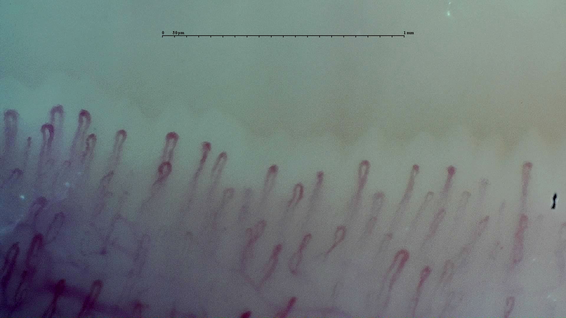 Nailfold capillaroscopy: left index finger, field d. Early SSc Cutolo Pattern: Representative Case.