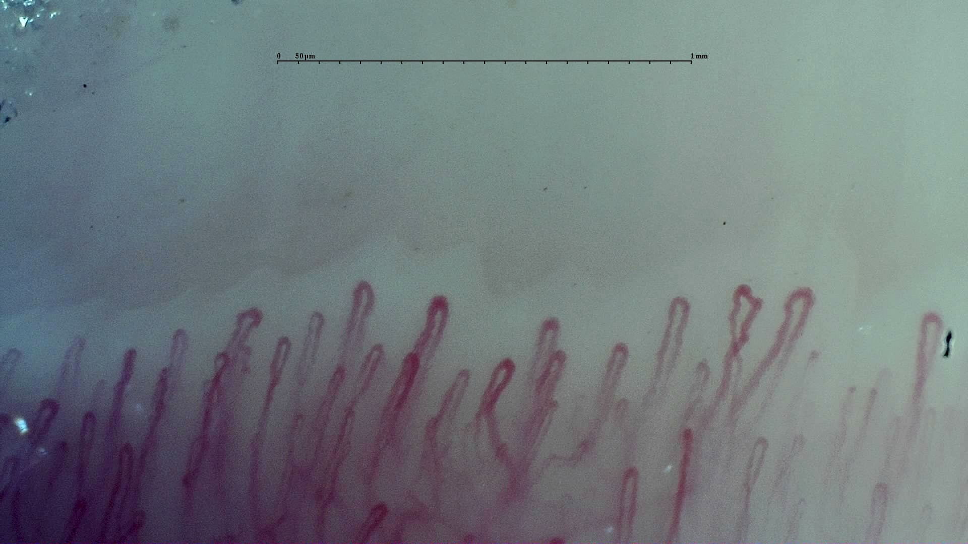 Nailfold capillaroscopy: right index finger, field d. Early SSc Cutolo Pattern: Representative Case.