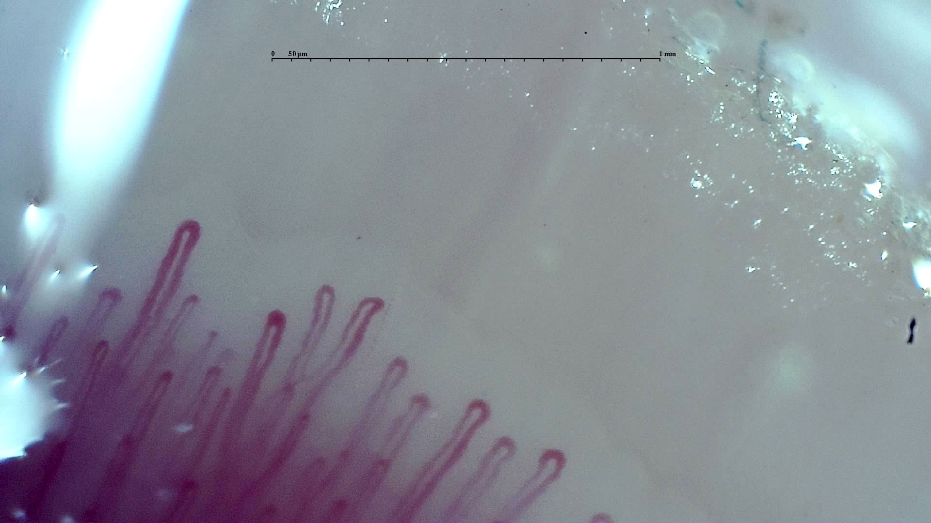 Nailfold capillaroscopy: right middle finger, field b. Early SSc Cutolo Pattern: Representative Case.