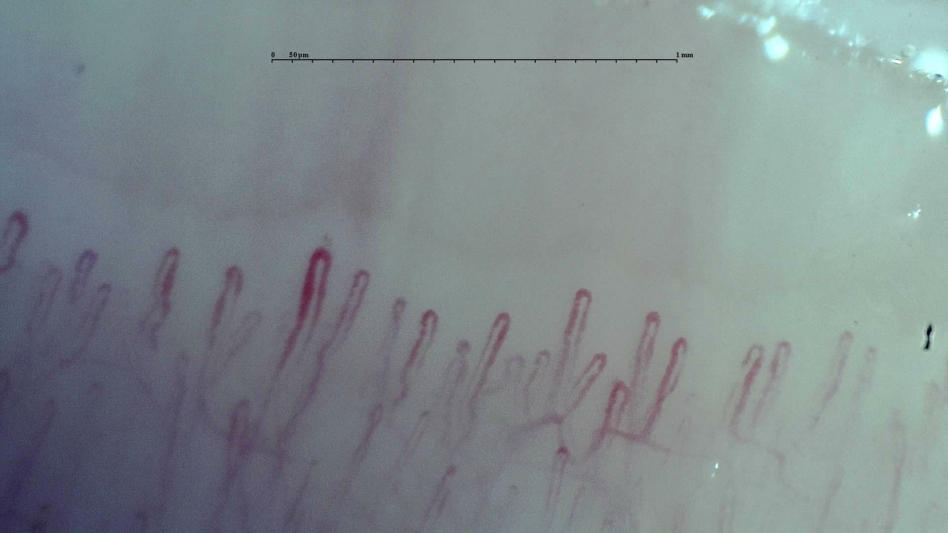 Nailfold capillaroscopy: right little finger, field b. Early SSc Cutolo Pattern: Representative Case.