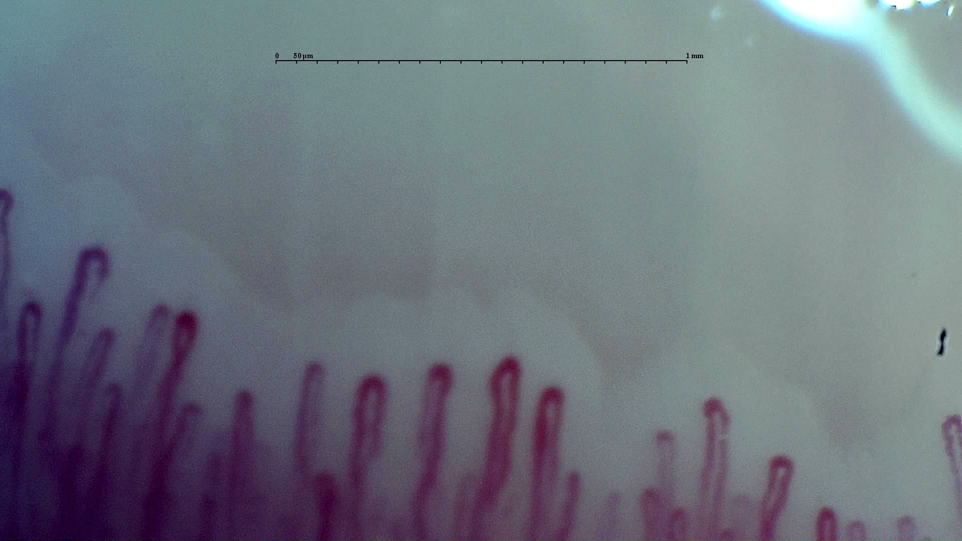 Nailfold capillaroscopy: left middle finger, field a. Early SSc Cutolo Pattern: Representative Case.