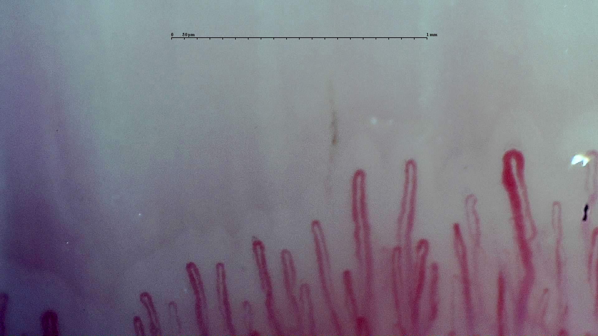 Nailfold capillaroscopy: left little finger, field d. Early SSc Cutolo Pattern: Representative Case.