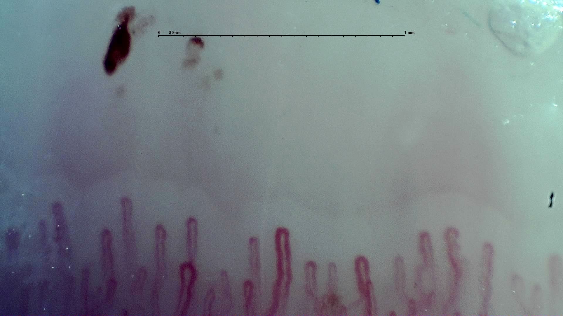 Nailfold capillaroscopy: right little finger, field c. Early SSc Cutolo Pattern: Representative Case.