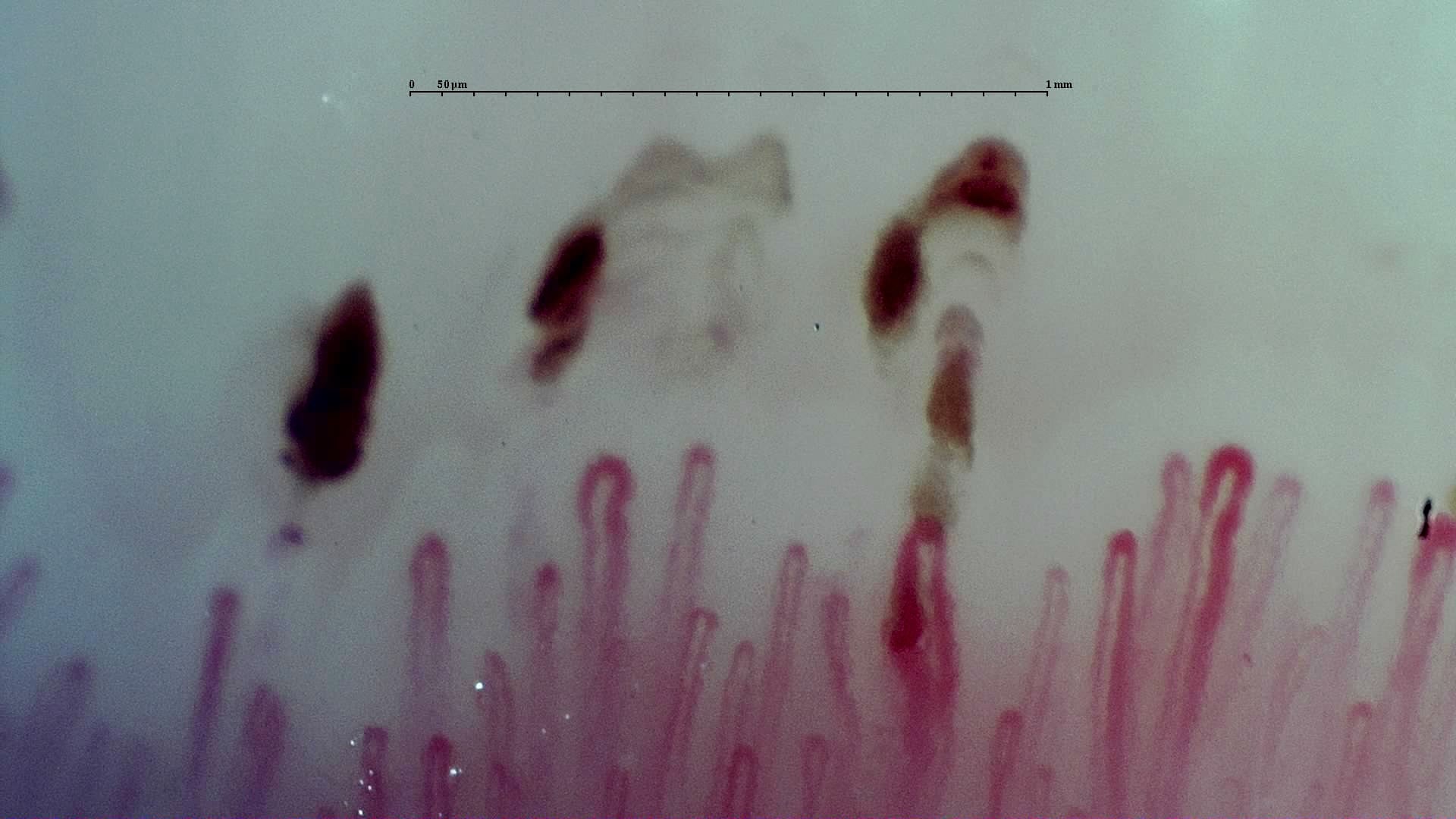 Nailfold capillaroscopy: right middle finger, field d. Early SSc Cutolo Pattern: Representative Case.
