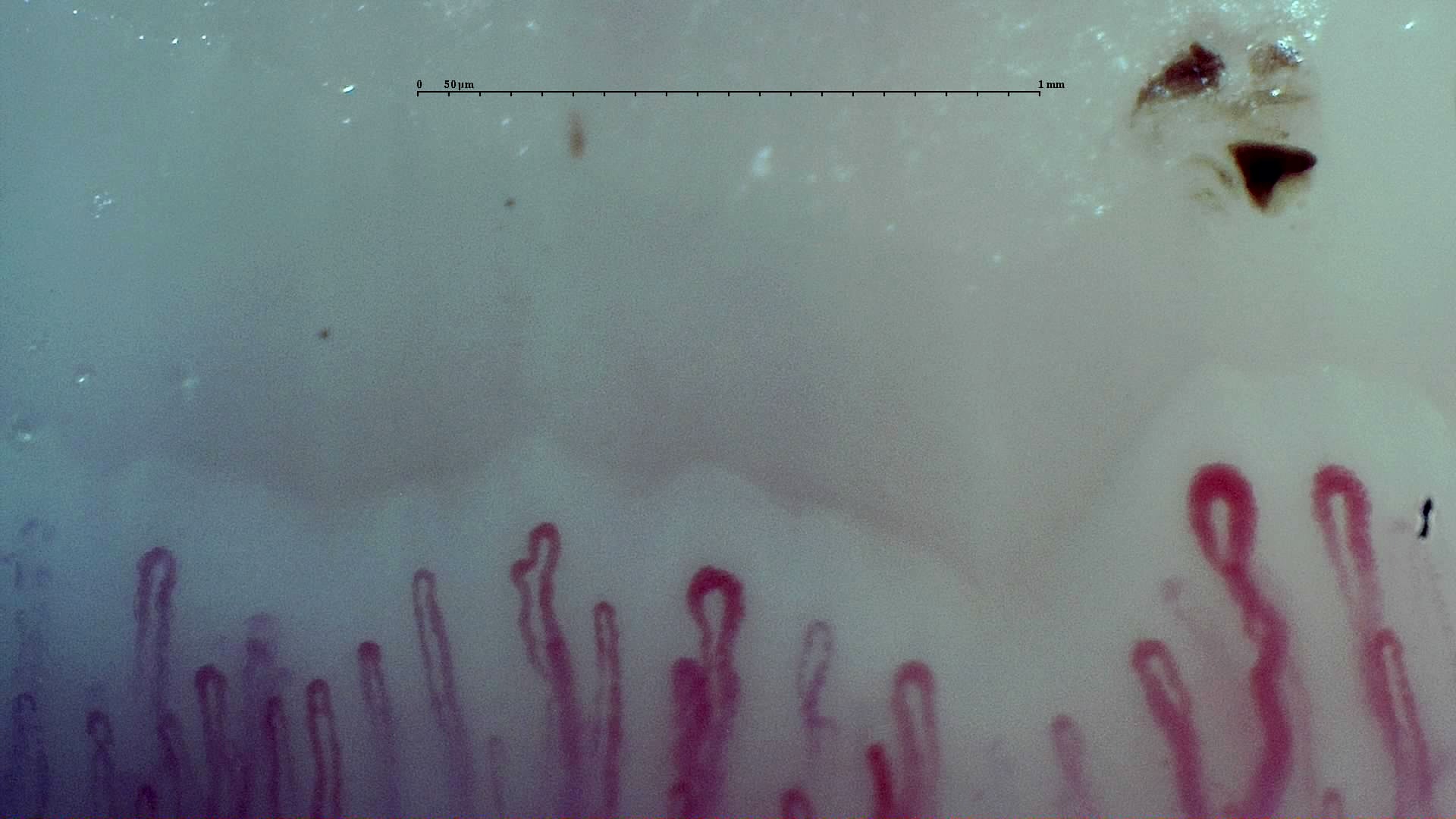 Early SSc Cutolo Pattern: Representative Case