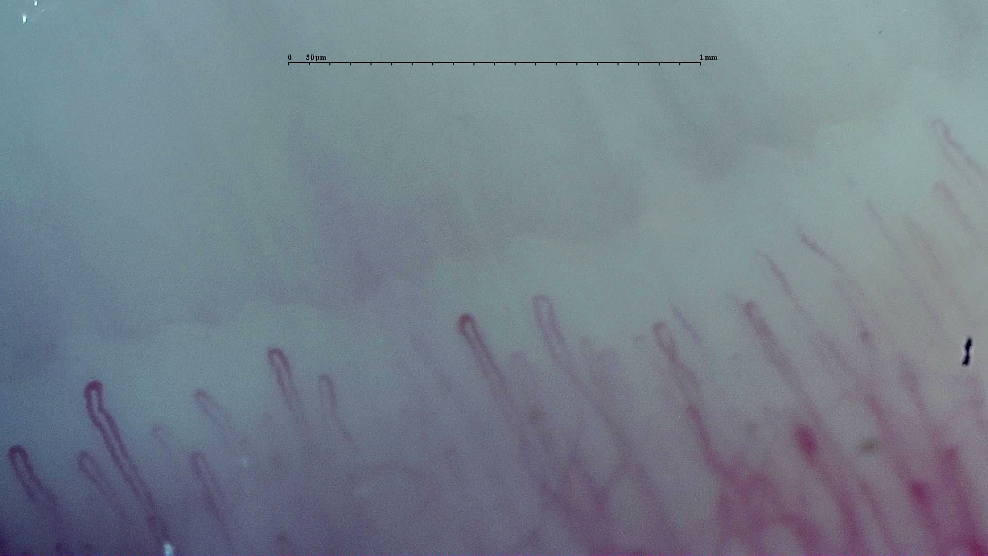 Nailfold capillaroscopy: right ring finger, field d. Early SSc Cutolo Pattern: Representative Case.