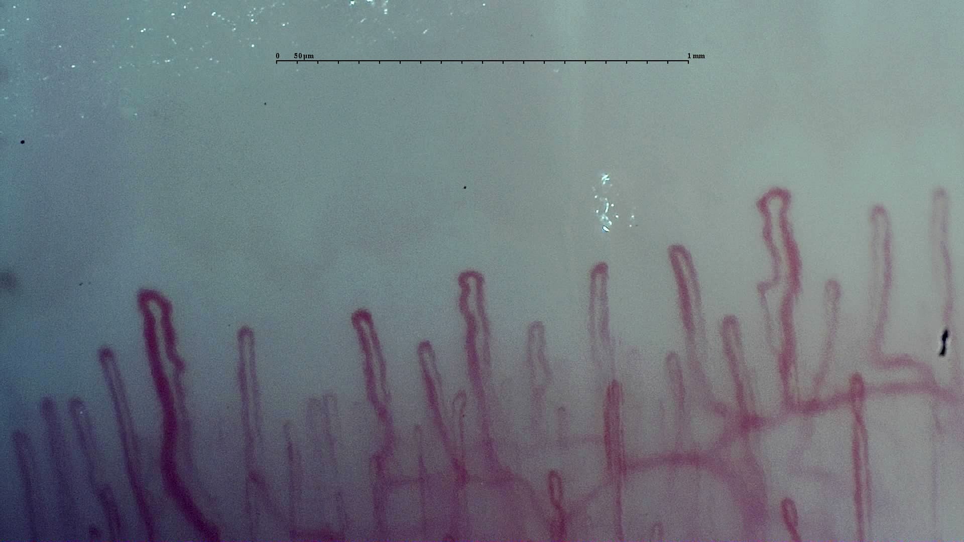 Nailfold capillaroscopy: left ring finger, field c. Early SSc Cutolo Pattern: Representative Case.