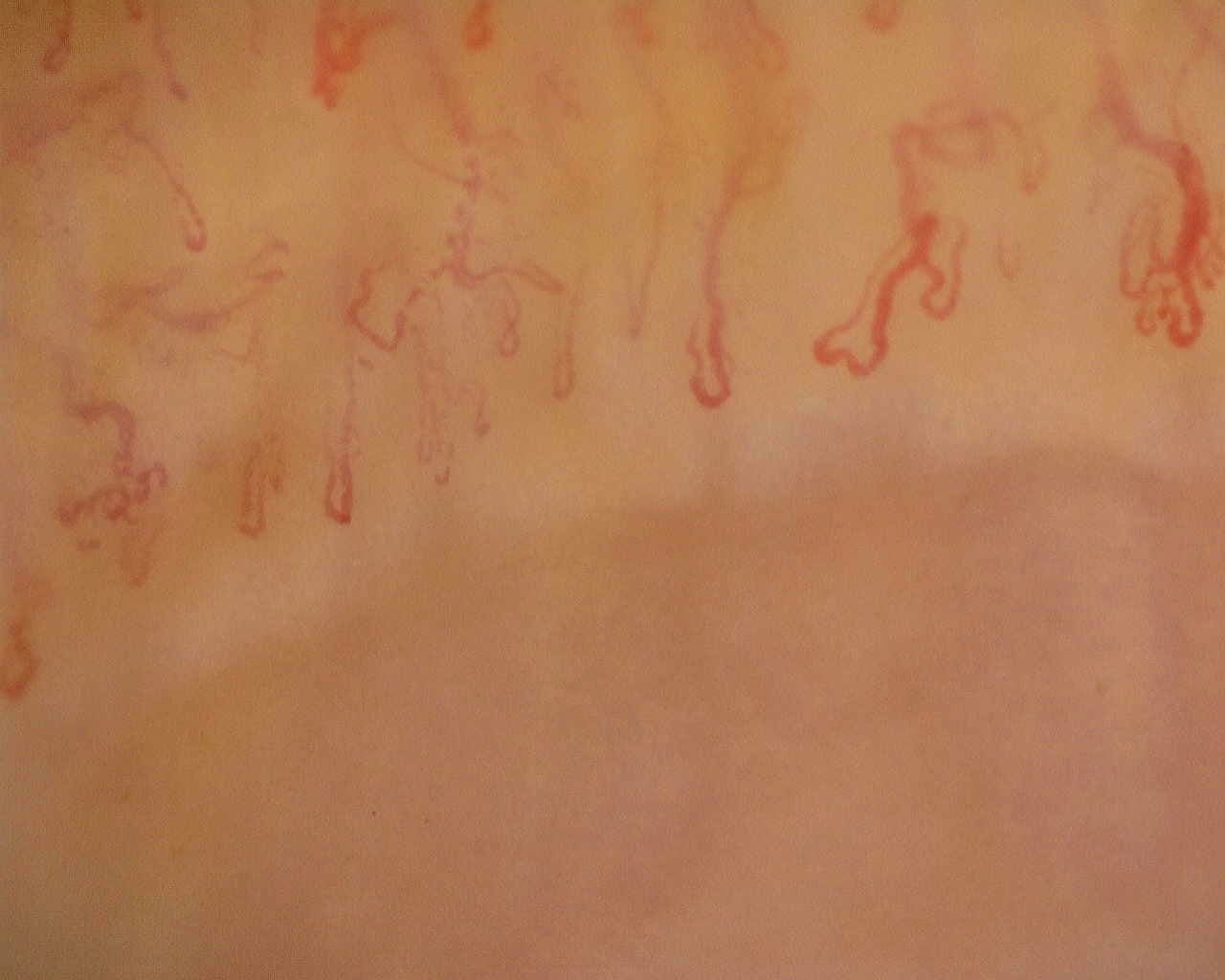 Nailfold capillaroscopy: left ring finger, field b. Late SSc Cutolo Pattern: Representative Case.