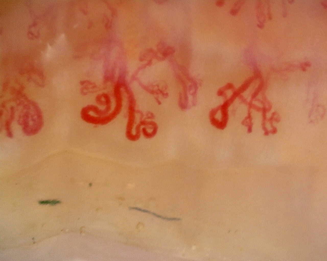 Nailfold capillaroscopy: left index finger, field c. Late SSc Cutolo Pattern: Representative Case.