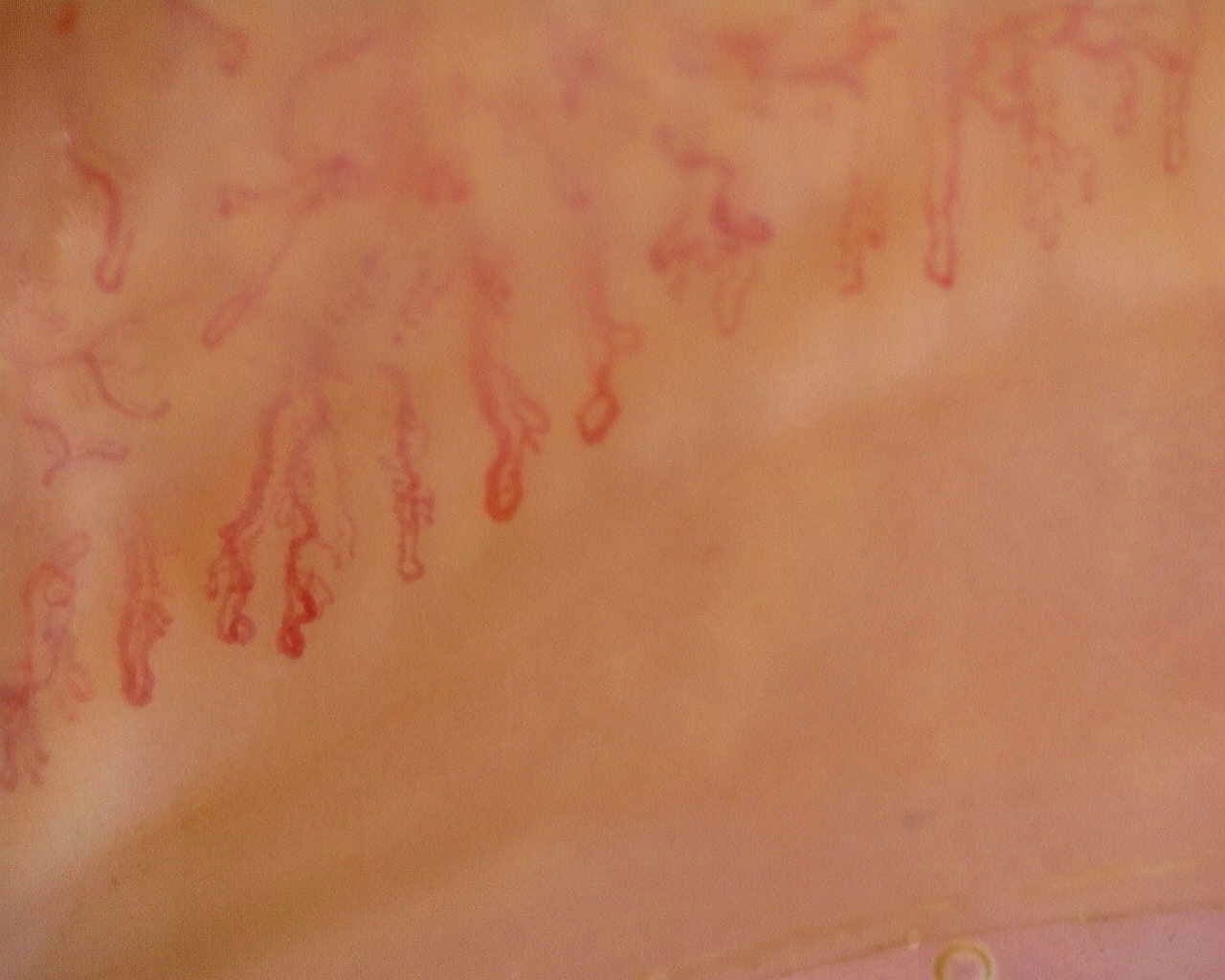 Nailfold capillaroscopy: left ring finger, field a. Late SSc Cutolo Pattern: Representative Case.