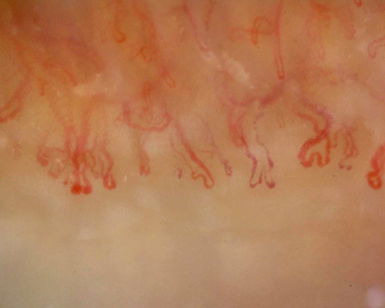 Nailfold capillaroscopy: right little finger, field b. Late SSc Cutolo Pattern: Representative Case.
