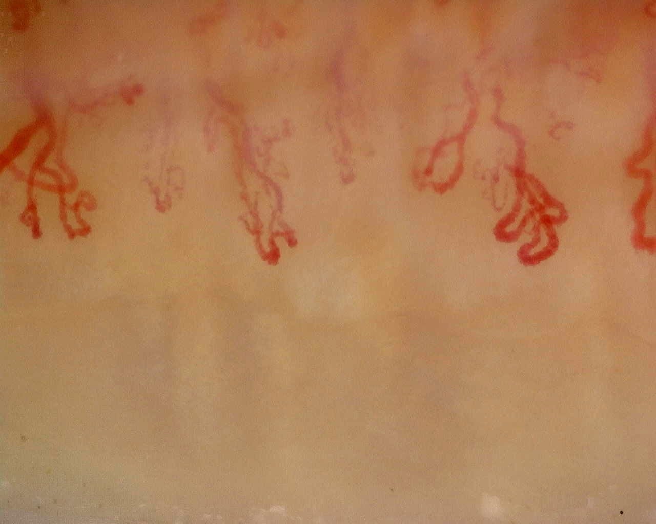 Nailfold capillaroscopy: left index finger, field d. Late SSc Cutolo Pattern: Representative Case.