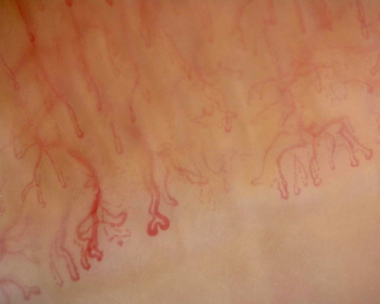 Nailfold capillaroscopy: left little finger, field d. Late SSc Cutolo Pattern: Representative Case.