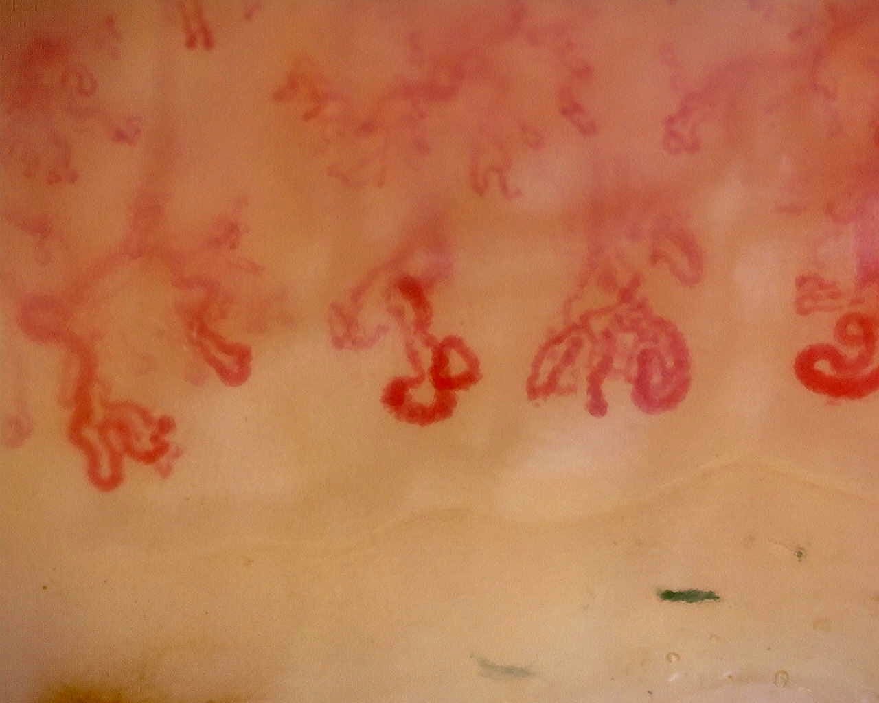 Nailfold capillaroscopy: left index finger, field b. Late SSc Cutolo Pattern: Representative Case.