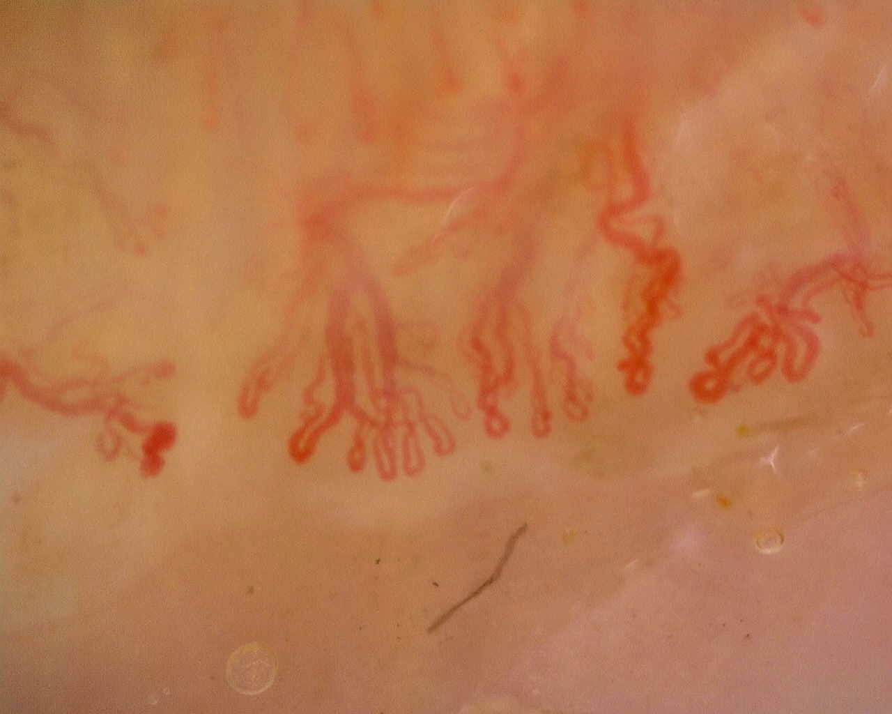 Nailfold capillaroscopy: left ring finger, field d. Late SSc Cutolo Pattern: Representative Case.