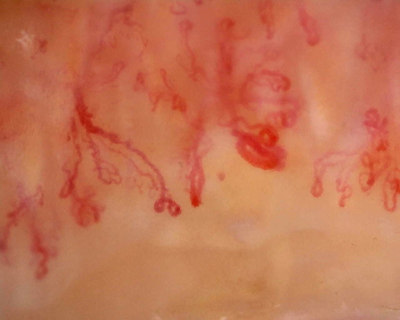 Nailfold capillaroscopy: left middle finger, field a. Late SSc Cutolo Pattern: Representative Case.