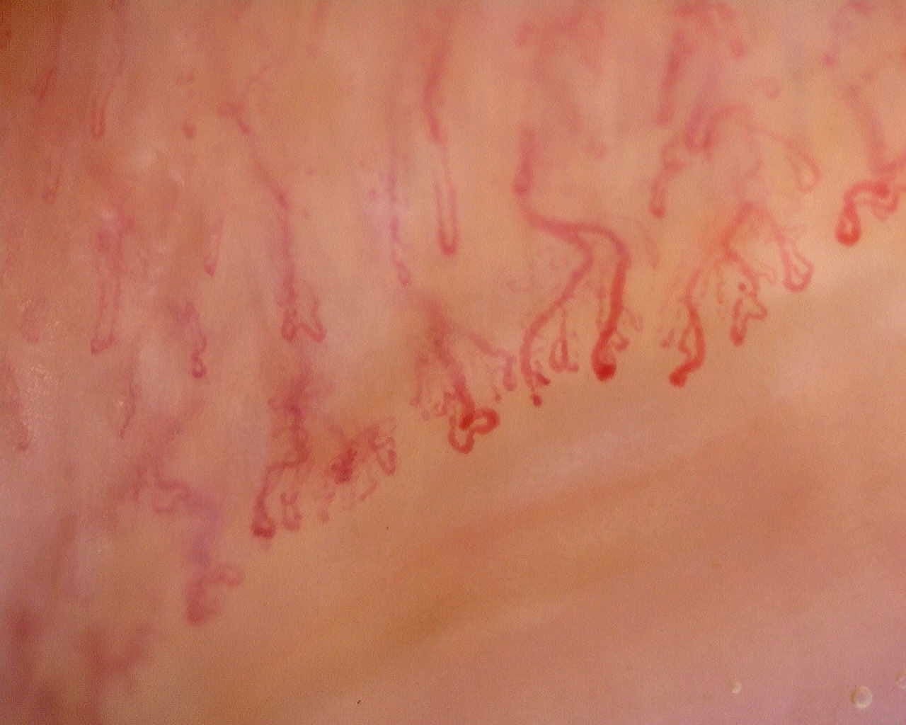 Nailfold capillaroscopy: left little finger, field a. Late SSc Cutolo Pattern: Representative Case.