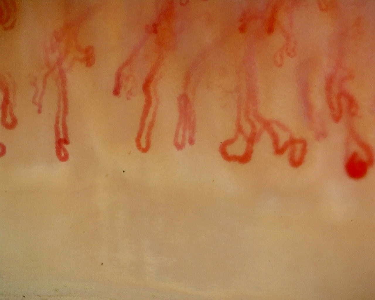 Nailfold capillaroscopy: right index finger, field b. Late SSc Cutolo Pattern: Representative Case.
