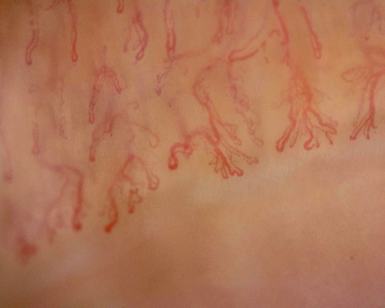 Nailfold capillaroscopy: left little finger, field b. Late SSc Cutolo Pattern: Representative Case.
