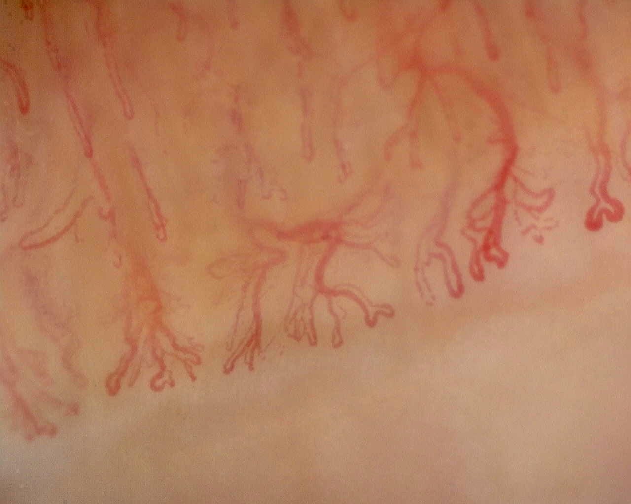Nailfold capillaroscopy: left little finger, field c. Late SSc Cutolo Pattern: Representative Case.