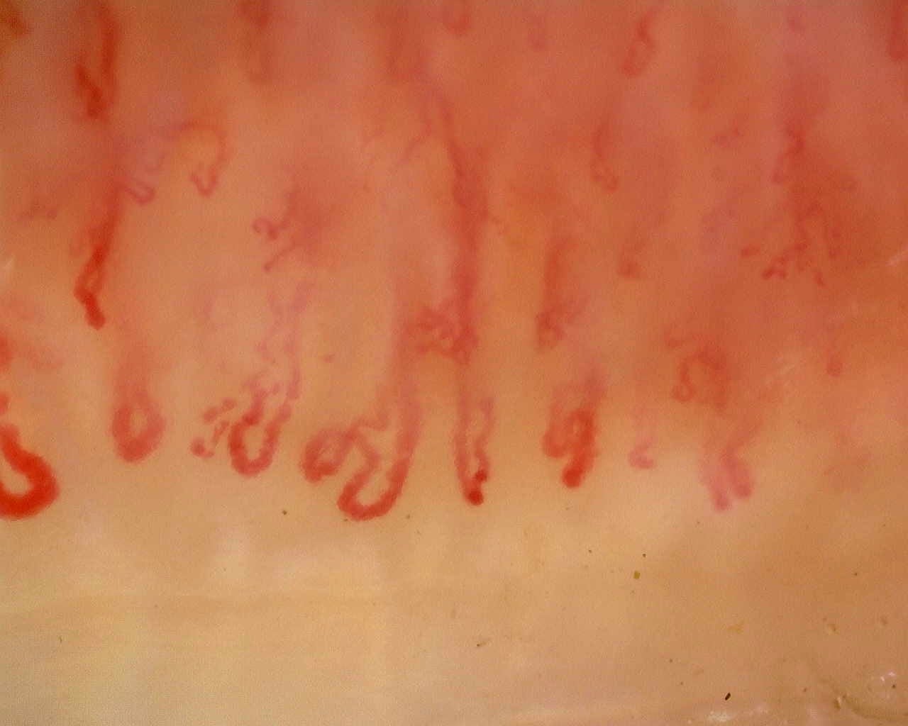 Nailfold capillaroscopy: right middle finger, field a. Late SSc Cutolo Pattern: Representative Case.