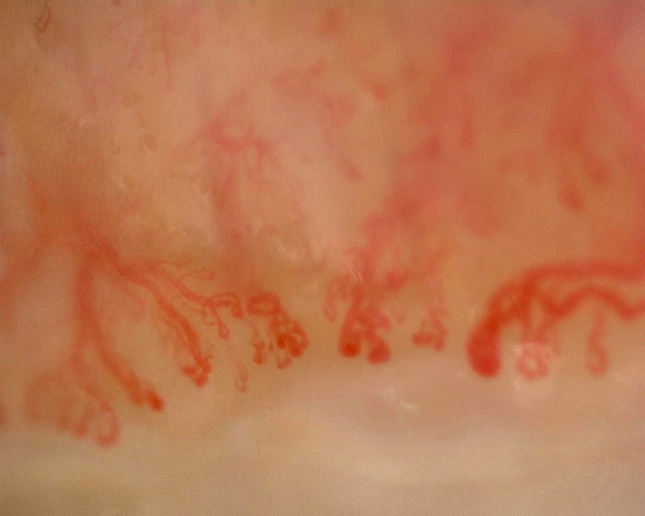 Nailfold capillaroscopy: right little finger, field d. Late SSc Cutolo Pattern: Representative Case.