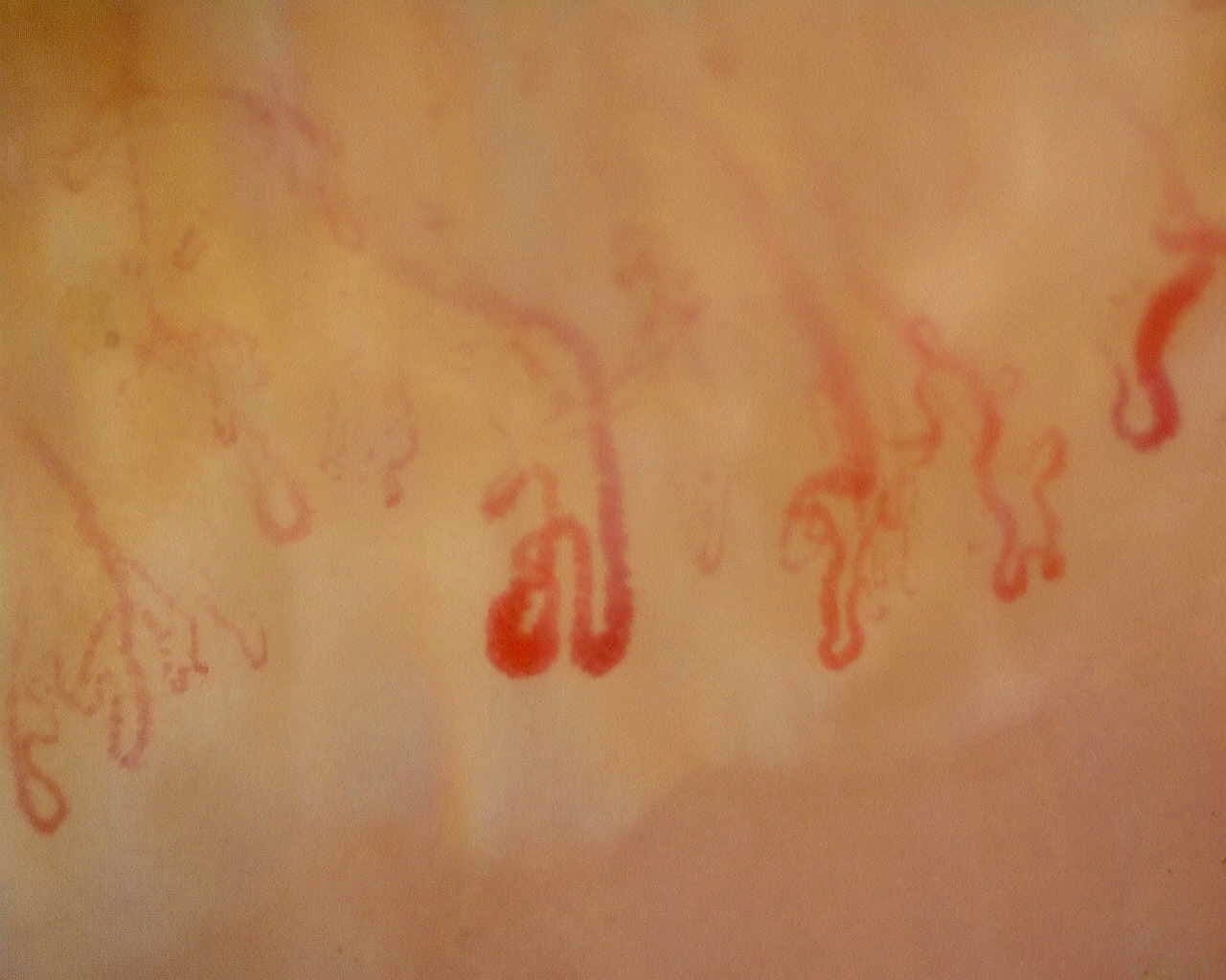 Nailfold capillaroscopy: left ring finger, field c. Late SSc Cutolo Pattern: Representative Case.