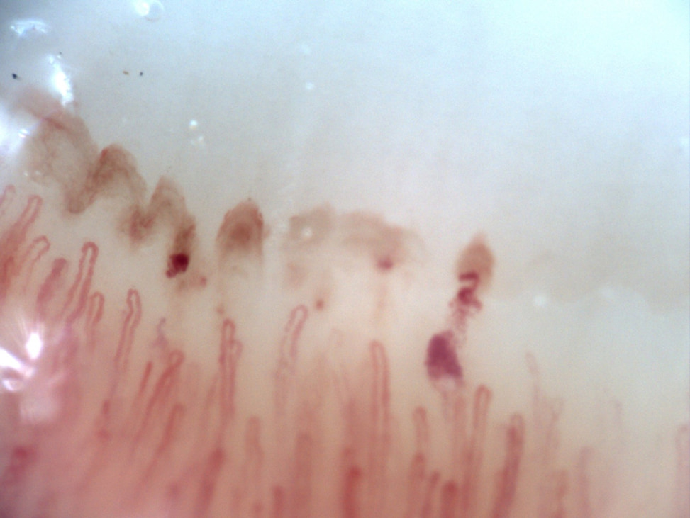 Nailfold video capillaroscopy of the right fourth finger showing preserved capillary density with hemorrhages and no giant capillaries