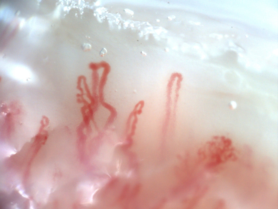 Nailfold video capillaroscopy in anti-TIF-1gamma antibody-positive dermatomyositis showing enlarged, giant, and ramified capillaries